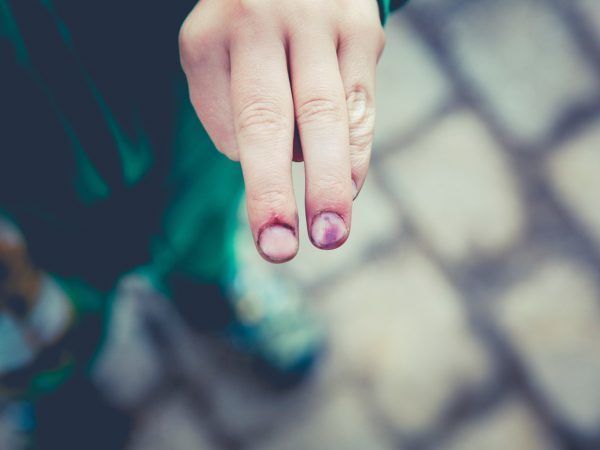 Gekneusde vingers vallen onder handletsel.